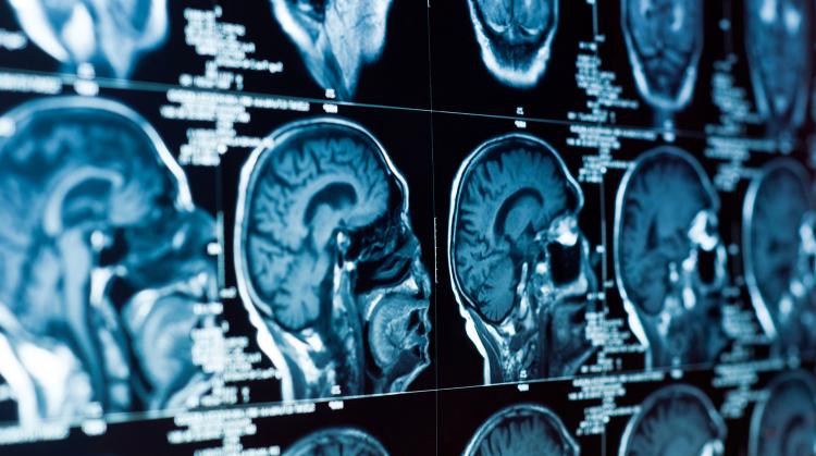 В России обнаружили пациента с половиной мозга 