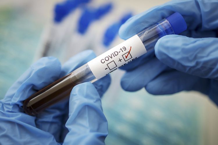 В Азербайджане число инфицированных коронавирусом достигло 33481 человек