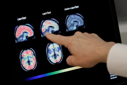 Медики развеяли мифы о болезни Альцгеймера