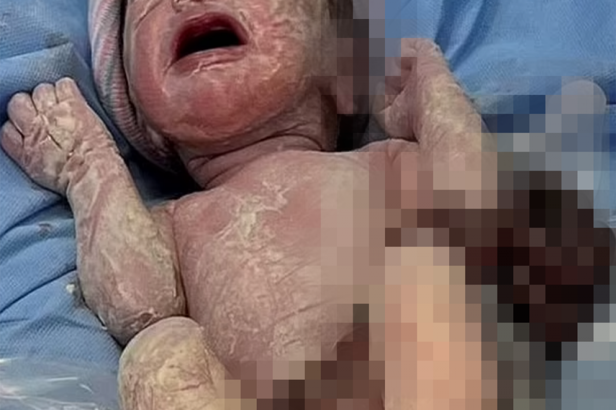 Британка родила "вывернутого наизнанку" ребенка с органами вне тела