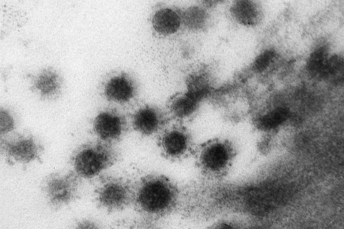 Ученые выяснили, как коронавирус поражает почки