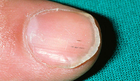 Полоски на ногтях назвали признаком серьезных проблем со здоровьем
