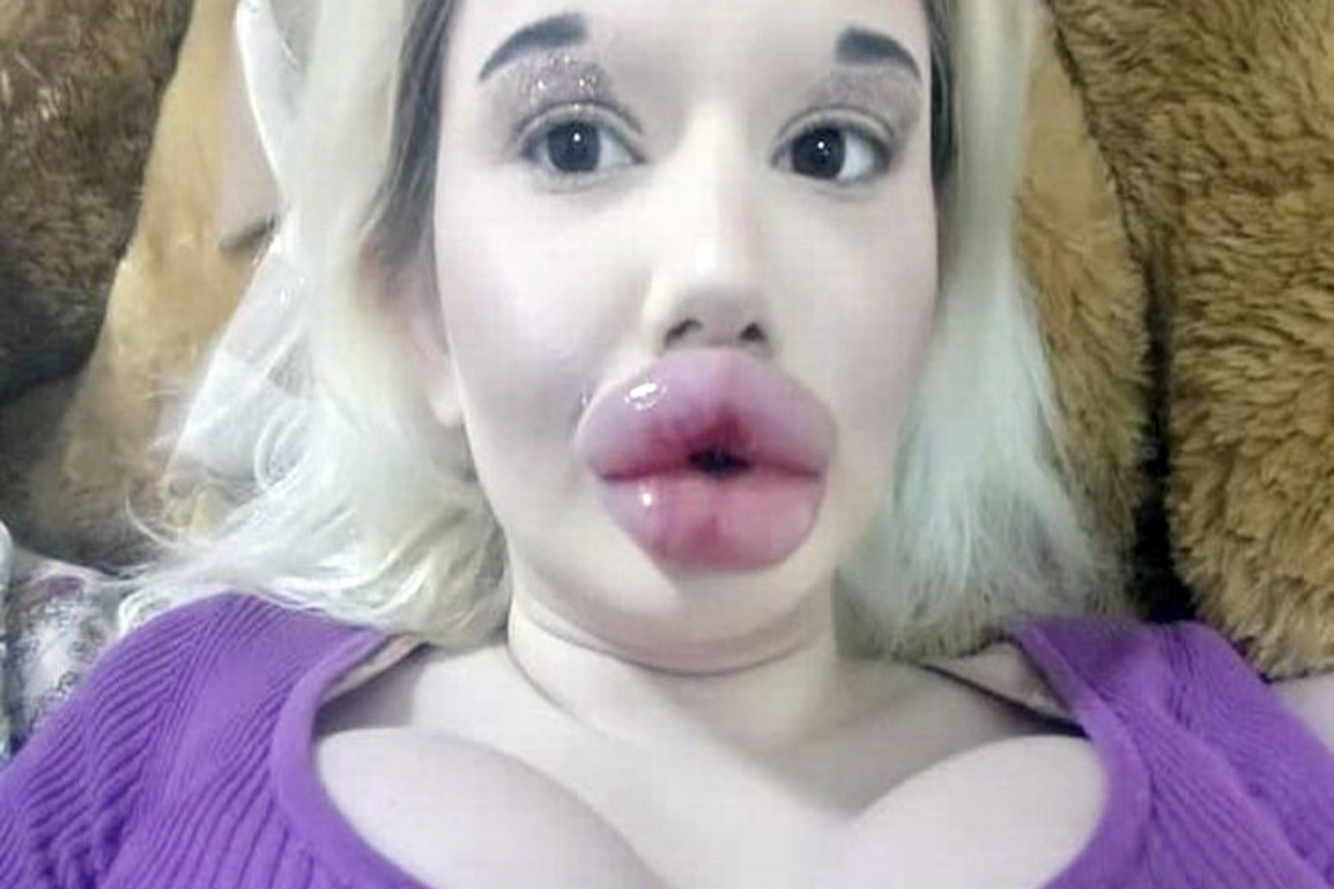 Девушка с самыми большими губами в мире планирует опять их увеличить