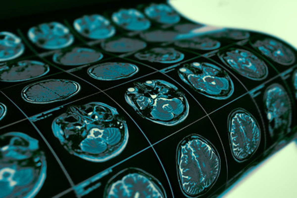 Ученые назвали способ предсказать приступ эпилепсии
