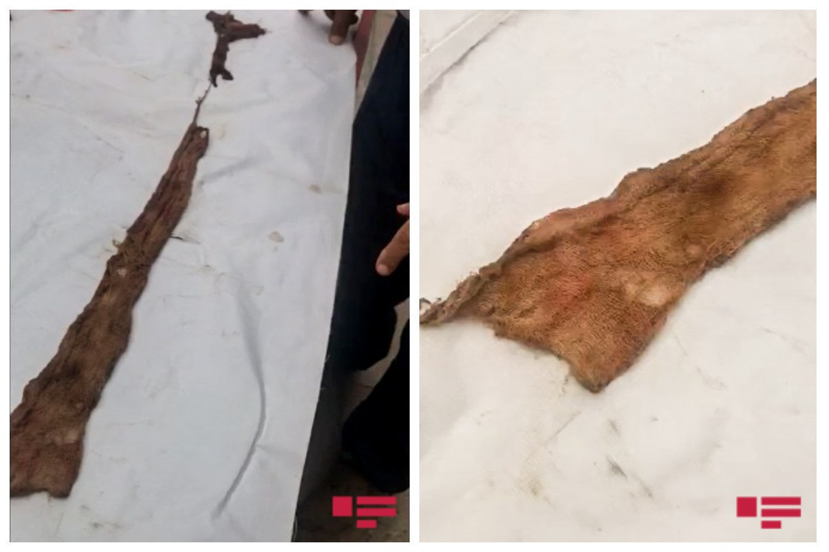 В животе жителя Ширвана обнаружен тампон, забытый во время операции 8 месяцев назад-ФОТО-ВИДЕО 