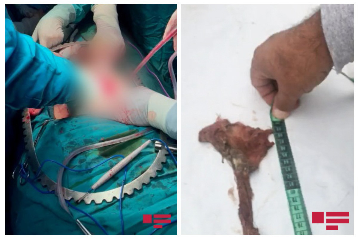 В животе жителя Ширвана обнаружен тампон, забытый во время операции 8 месяцев назад-ФОТО-ВИДЕО 
