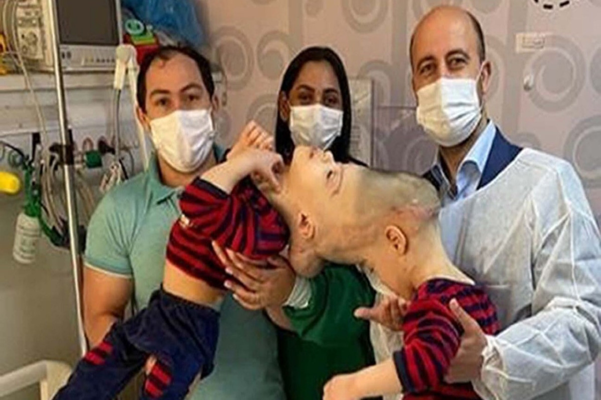 В Бразилии успешно разделили сиамских близнецов с общим мозгом-ФОТО 