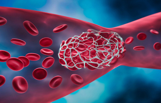 Кардиолог перечислил главные факторы риска развития тромбоза