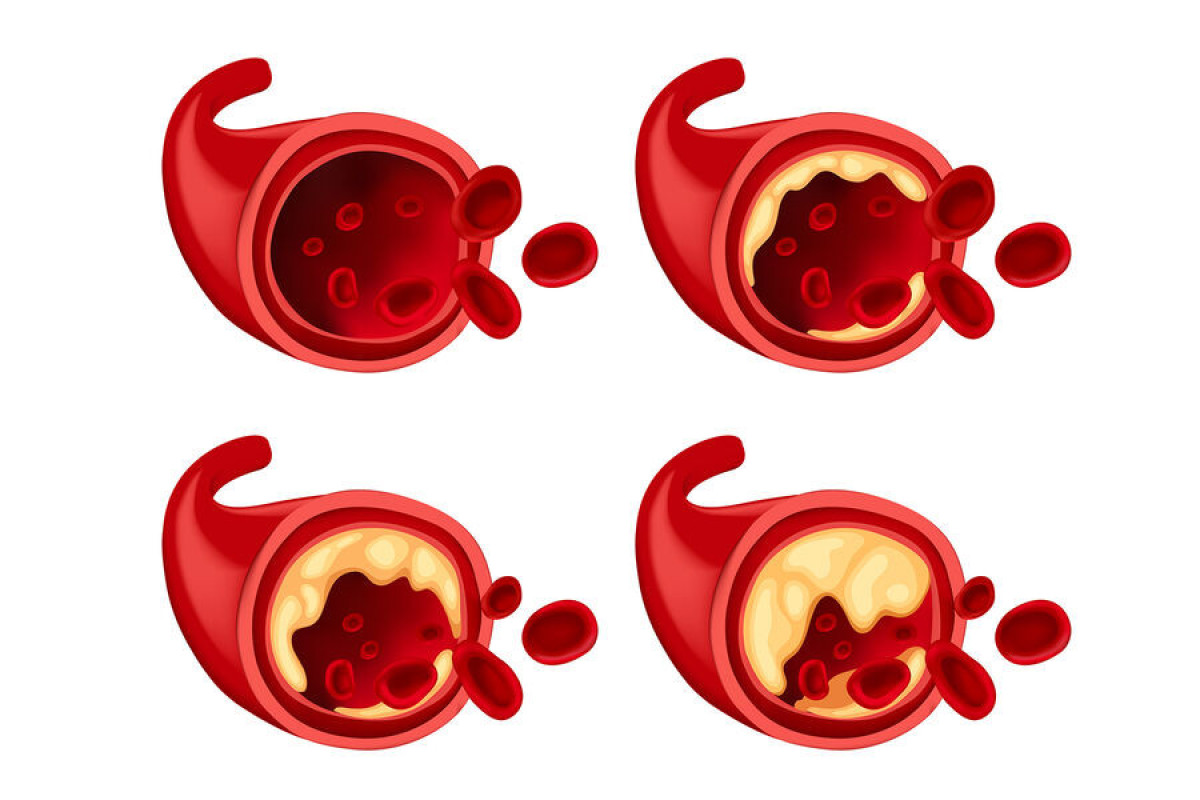 Найден способ остановить образование бляшек на стенках сосудов