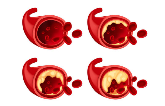 Найден способ остановить образование бляшек на стенках сосудов