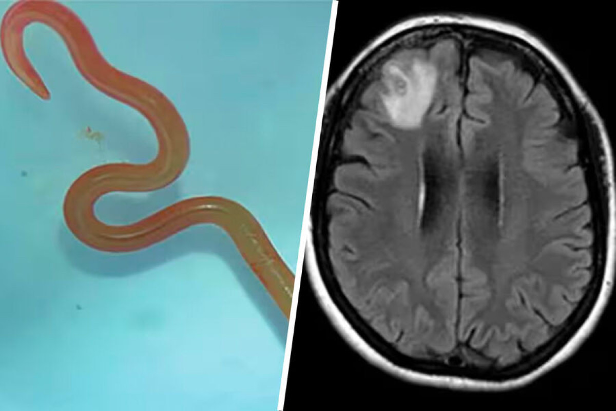 В Австралии хирурги извлекли живого червя из мозга пациентки - The Guardian 