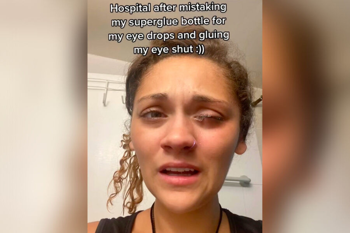 Американка перепутала суперклей с глазными каплями и попала в больницу