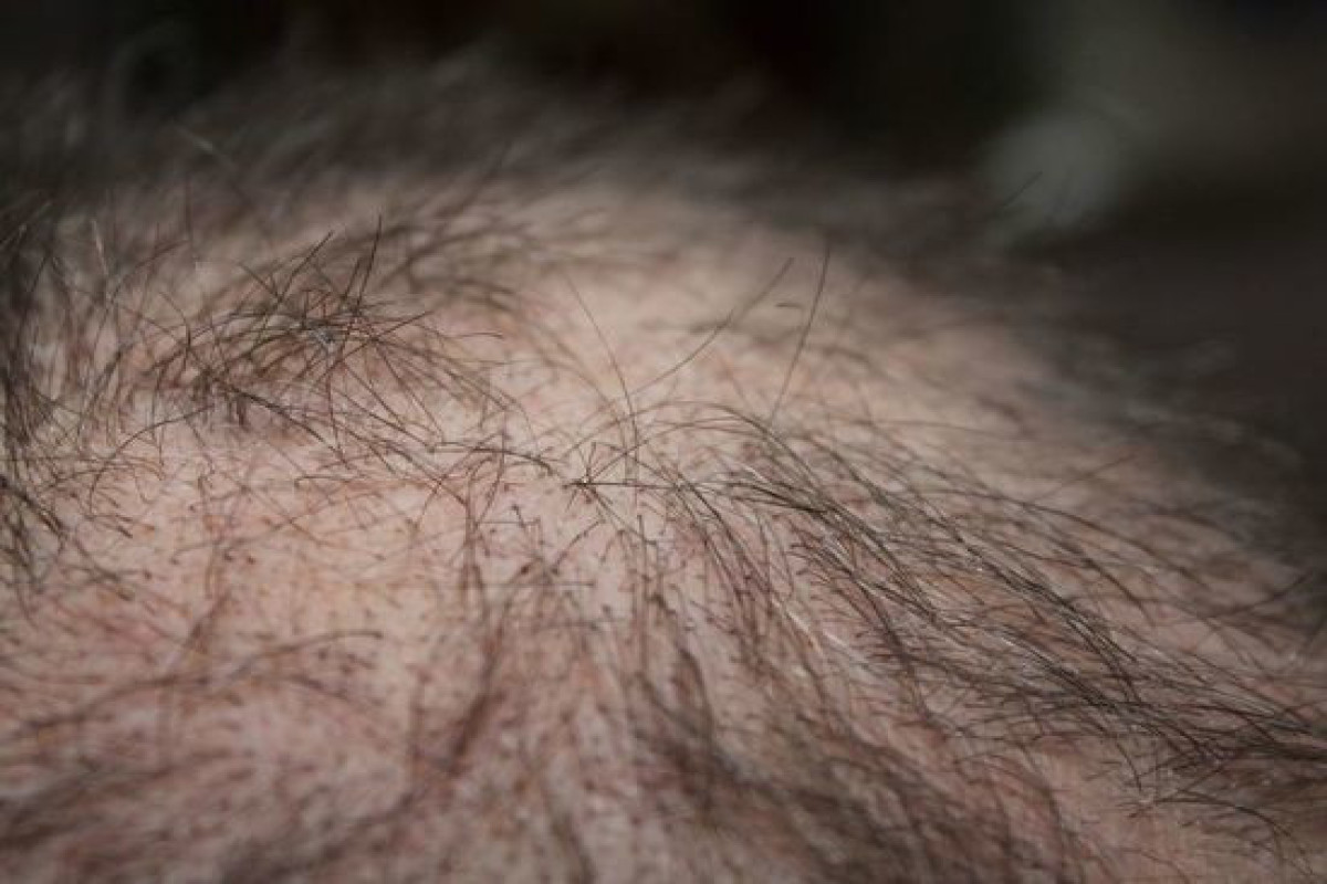 Названы 5 причин выпадения волос, приводящих к облысению
