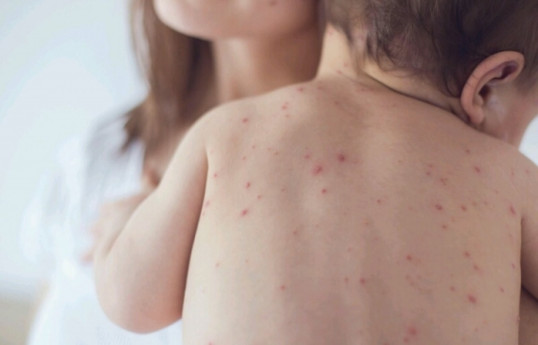 В Азербайджане прокомментировали ситуацию с корью в стране