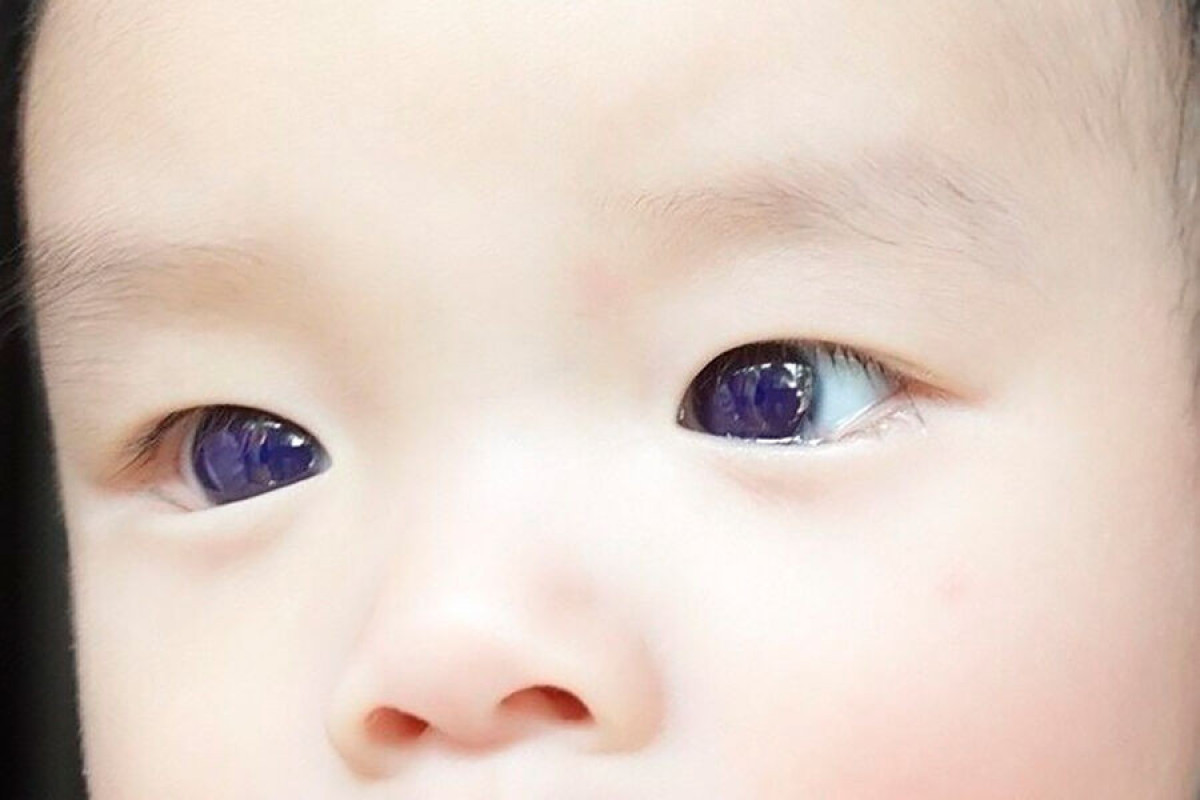 У младенца поменялся цвет глаз после приема препарата для лечения коронавируса
