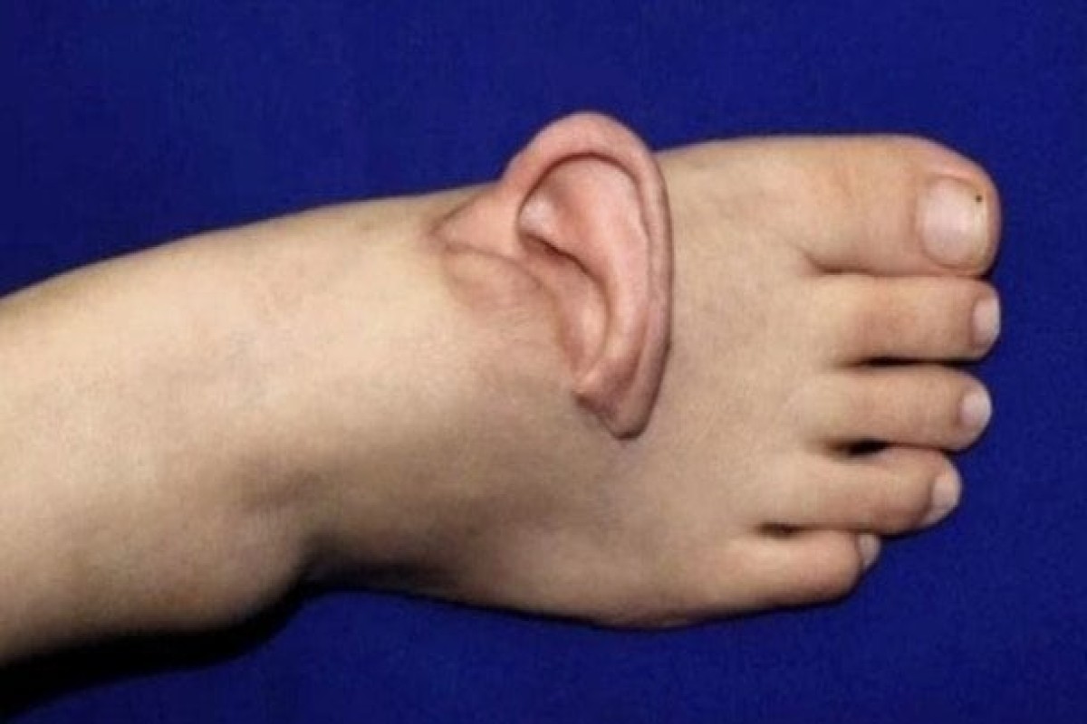 В Китае провели уникальную операцию по спасению оторванного уха