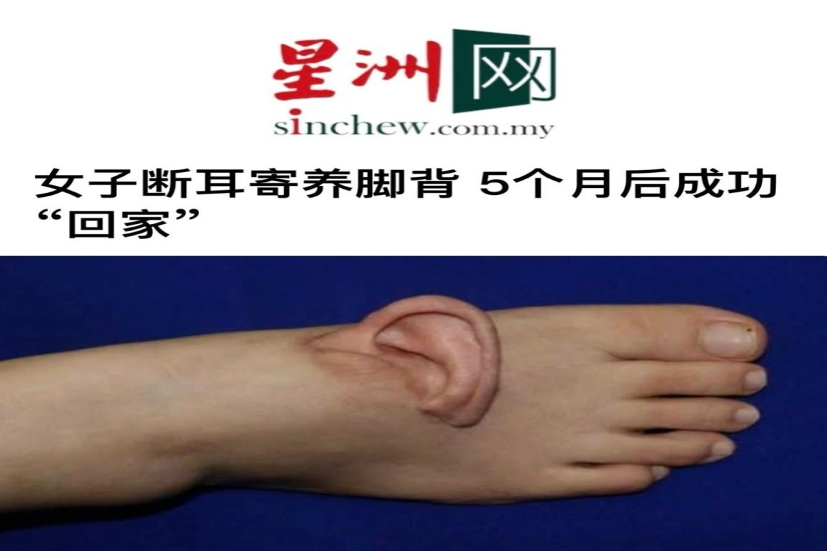 В Китае провели уникальную операцию по спасению оторванного уха