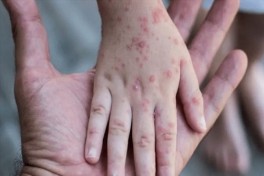 В Гонконге произошла вспышка оспы обезьян
